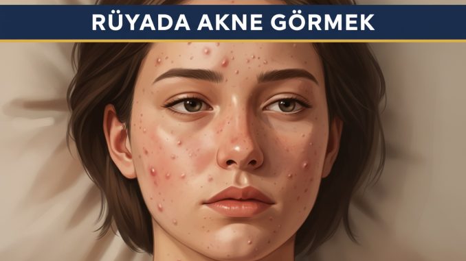 "Rüyada Akne Görmek"